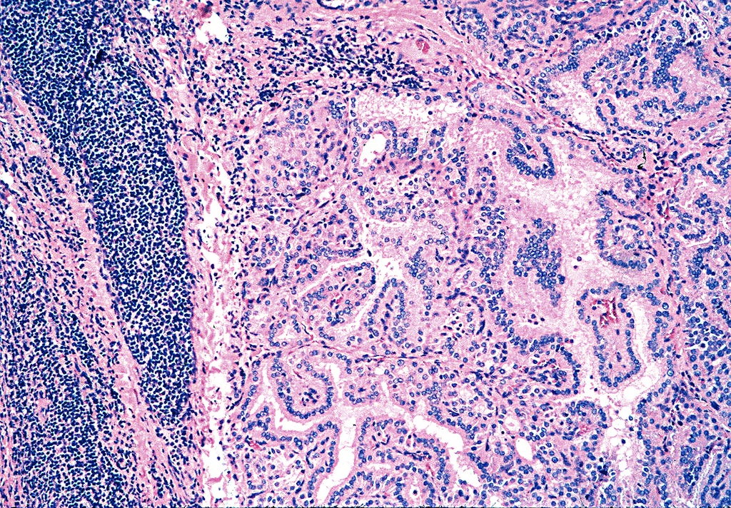 Graves Disease Histology Hashimoto Thyroiditis Pathology Student